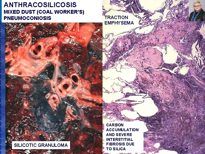 ANTHRACOSILICOSIS MIXED DUST (COAL WORKER’S) PNEUMOCONIOSIS SILICOTIC GRANULOMA TRACTION EMPHYSEMA CARBON ACCUMULATION AND SEVERE