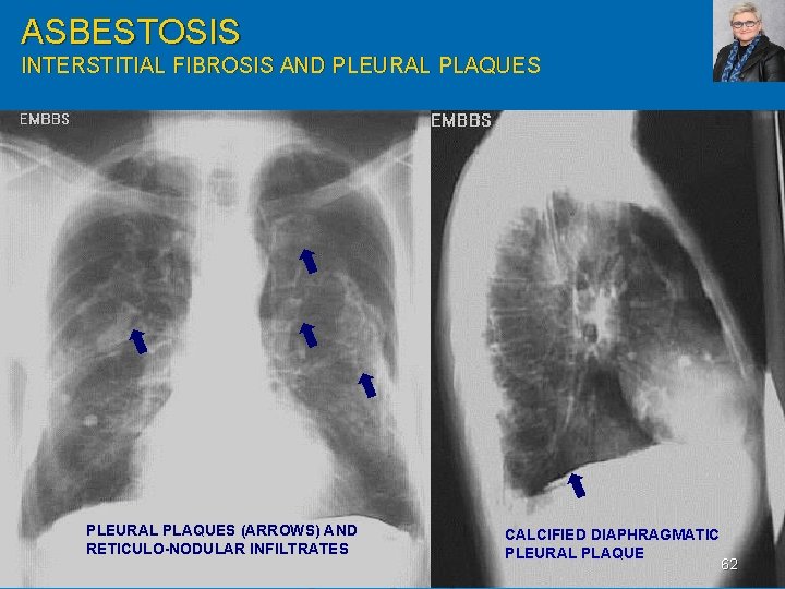 ASBESTOSIS INTERSTITIAL FIBROSIS AND PLEURAL PLAQUES (ARROWS) AND RETICULO-NODULAR INFILTRATES CALCIFIED DIAPHRAGMATIC PLEURAL PLAQUE