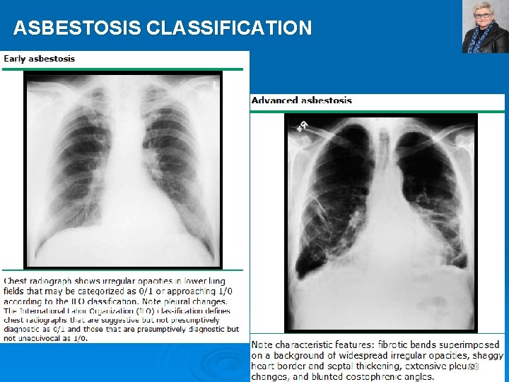 ASBESTOSIS CLASSIFICATION 63 