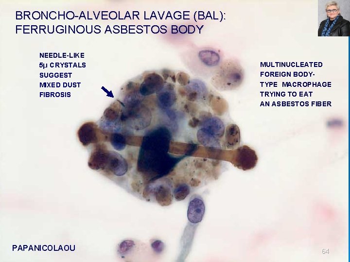 BRONCHO ALVEOLAR LAVAGE (BAL): FERRUGINOUS ASBESTOS BODY NEEDLE-LIKE 5µ CRYSTALS SUGGEST MIXED DUST FIBROSIS