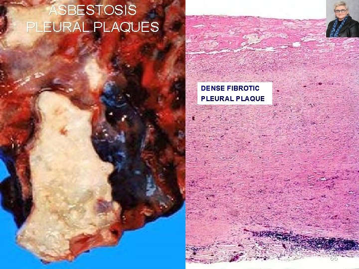 ASBESTOSIS PLEURAL PLAQUES DENSE FIBROTIC PLEURAL PLAQUE 66 