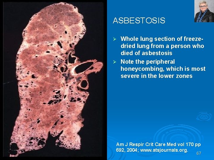 ASBESTOSIS Whole lung section of freezedried lung from a person who died of asbestosis