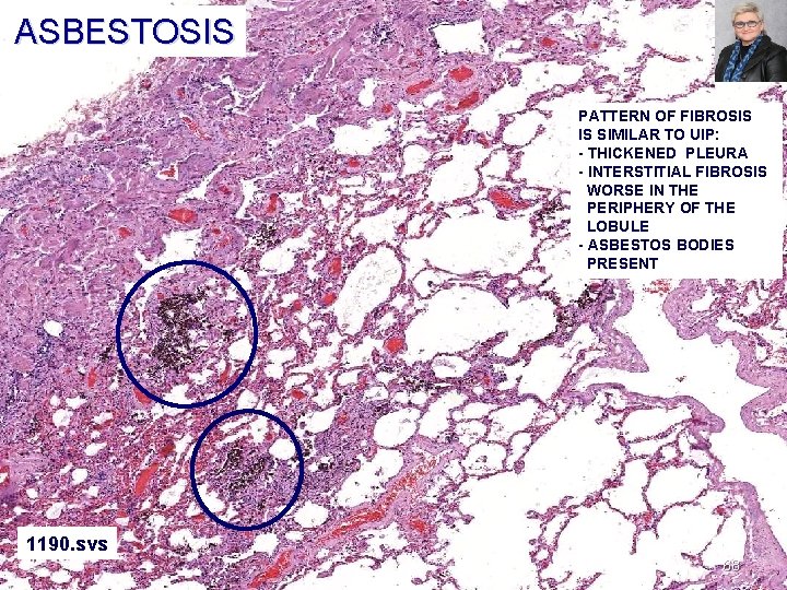 ASBESTOSIS CASE 5 PATTERN OF FIBROSIS IS SIMILAR TO UIP: - THICKENED PLEURA -