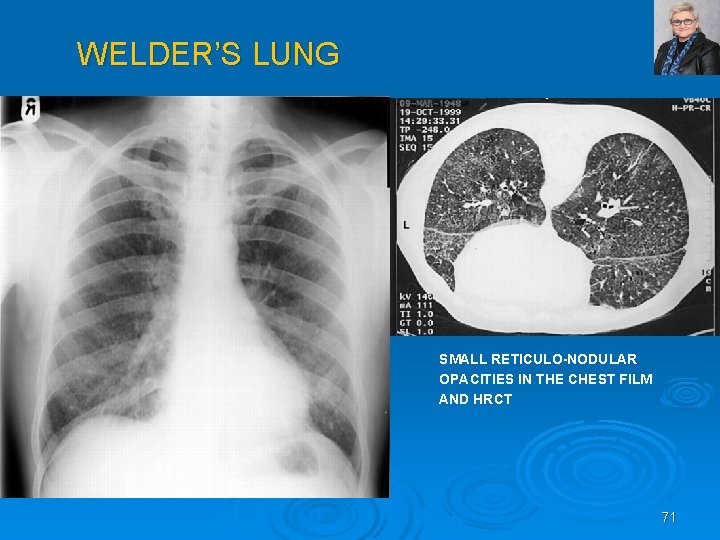 WELDER’S LUNG SMALL RETICULO-NODULAR OPACITIES IN THE CHEST FILM AND HRCT 71 