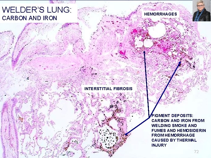 WELDER’S LUNG: HEMORRHAGES CARBON AND IRON INTERSTITIAL FIBROSIS PIGMENT DEPOSITS: CARBON AND IRON FROM