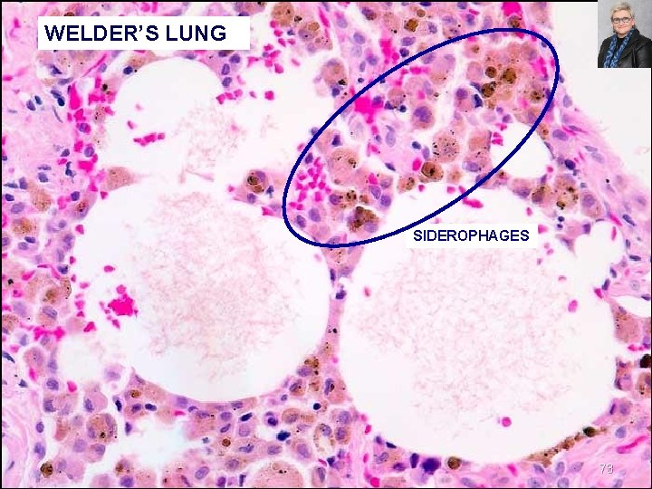 WELDER’S LUNG SIDEROPHAGES 73 