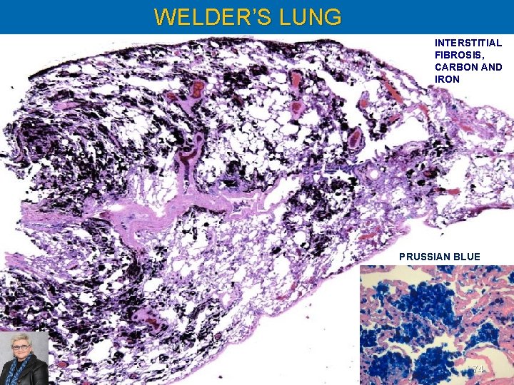 WELDER’S LUNG INTERSTITIAL FIBROSIS, CARBON AND IRON PRUSSIAN BLUE 74 