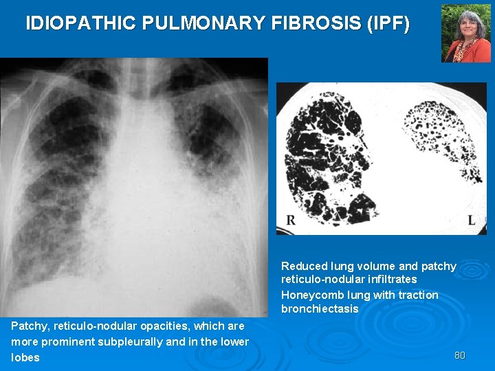 IDIOPATHIC PULMONARY FIBROSIS (IPF) Reduced lung volume and patchy reticulo-nodular infiltrates Honeycomb lung with