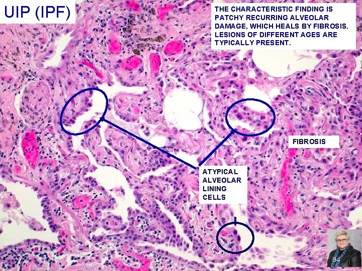 UIP (IPF) UIP (IPF THE CHARACTERISTIC FINDING IS PATCHY RECURRING ALVEOLAR DAMAGE, WHICH HEALS