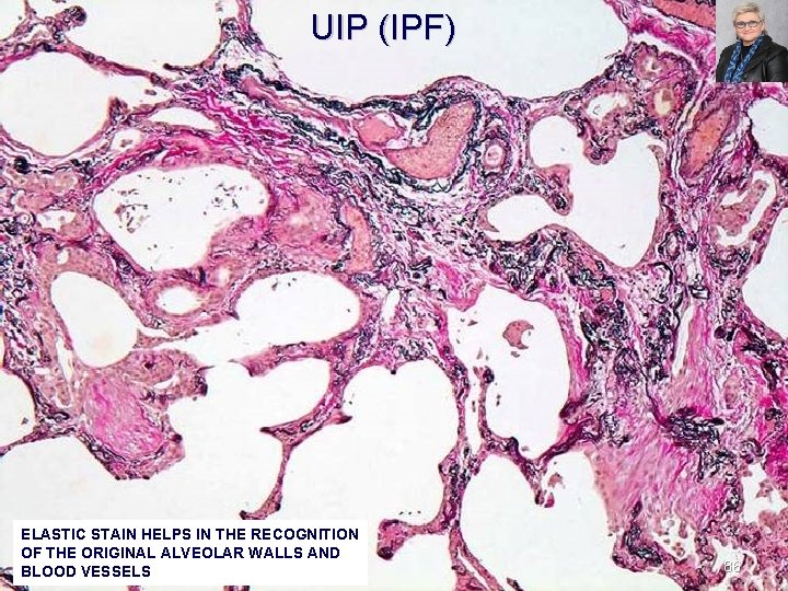 UIP (IPF) ELASTIC STAIN HELPS IN THE RECOGNITION OF THE ORIGINAL ALVEOLAR WALLS AND