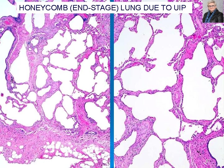 HONEYCOMB (END STAGE) LUNG DUE TO UIP PLEURA 87 