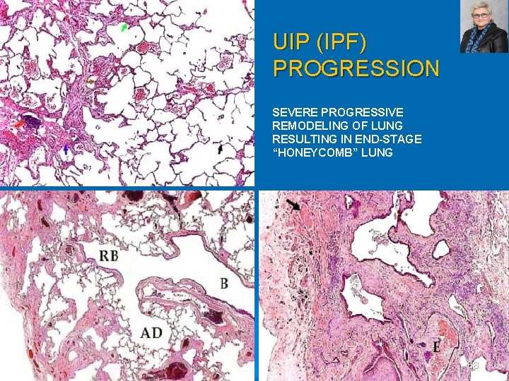 UIP (IPF) PROGRESSION SEVERE PROGRESSIVE REMODELING OF LUNG RESULTING IN END-STAGE “HONEYCOMB” LUNG 88