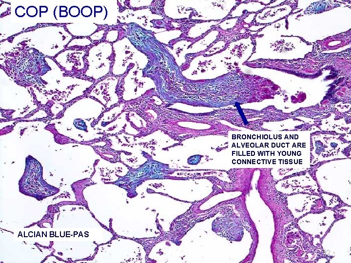 COP (BOOP) BRONCHIOLUS AND ALVEOLAR DUCT ARE FILLED WITH YOUNG CONNECTIVE TISSUE ALCIAN BLUE-PAS