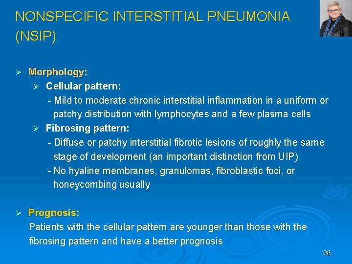 NONSPECIFIC INTERSTITIAL PNEUMONIA (NSIP) Morphology: Ø Cellular pattern: Mild to moderate chronic interstitial inflammation