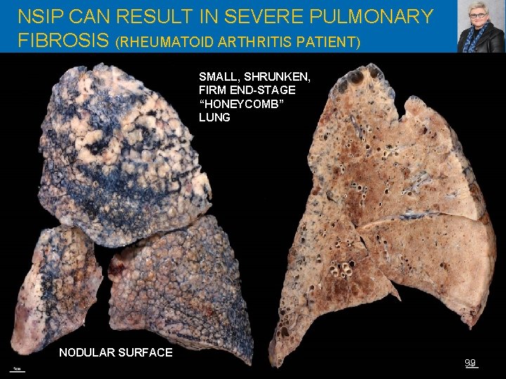 NSIP CAN RESULT IN SEVERE PULMONARY FIBROSIS (RHEUMATOID ARTHRITIS PATIENT) SMALL, SHRUNKEN, FIRM END-STAGE