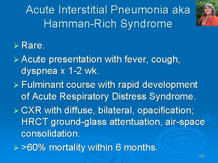 Acute Interstitial Pneumonia aka Hamman Rich Syndrome Ø Rare. Ø Acute presentation with fever,