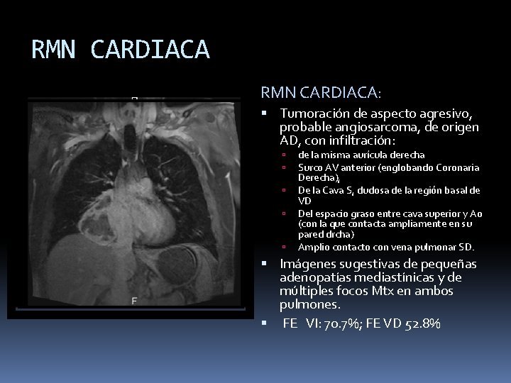 RMN CARDIACA: Tumoración de aspecto agresivo, probable angiosarcoma, de origen AD, con infiltración: de