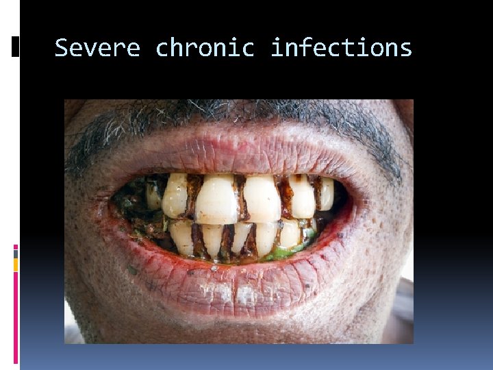 Severe chronic infections 