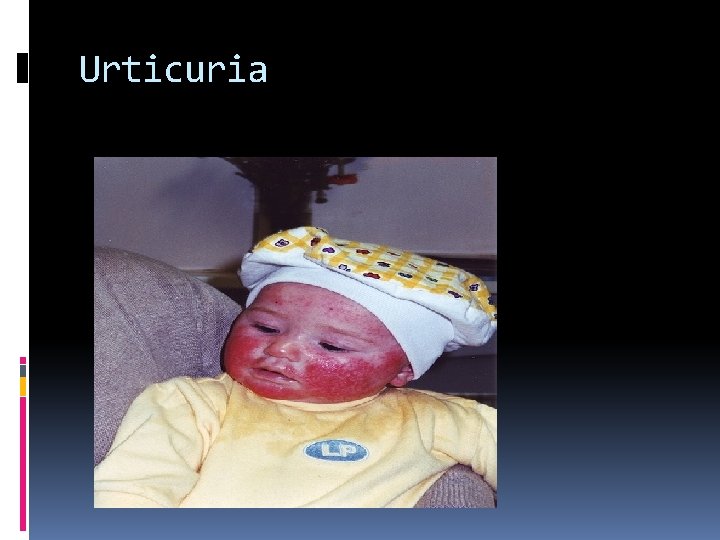 Urticuria 