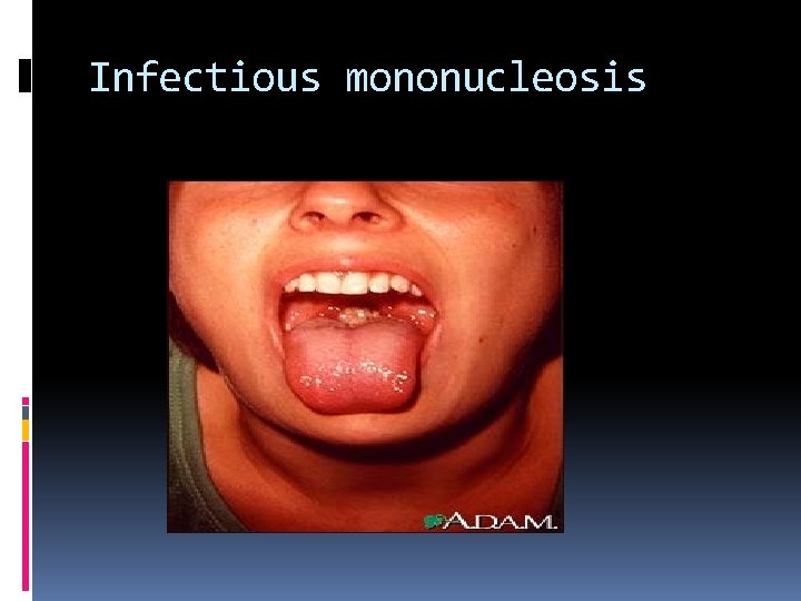 Infectious mononucleosis 