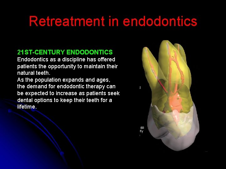 Retreatment in endodontics 21 ST-CENTURY ENDODONTICS Endodontics as a discipline has offered patients the