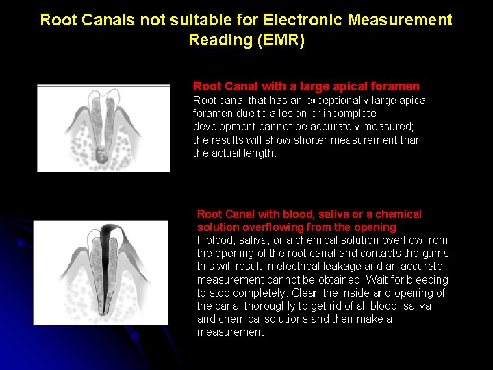 Root Canals not suitable for Electronic Measurement Reading (EMR) Root Canal with a large