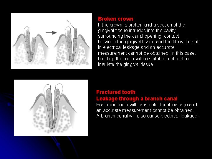 Broken crown If the crown is broken and a section of the gingival tissue