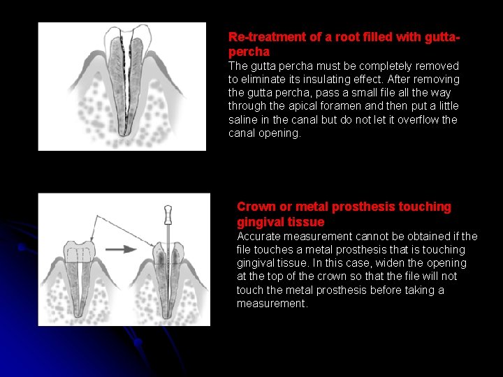 Re-treatment of a root filled with guttapercha The gutta percha must be completely removed
