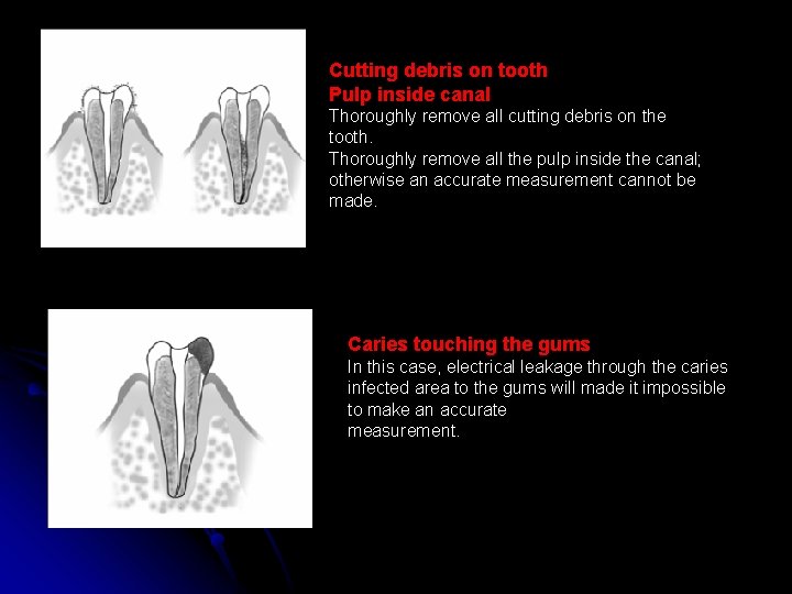 Cutting debris on tooth Pulp inside canal Thoroughly remove all cutting debris on the