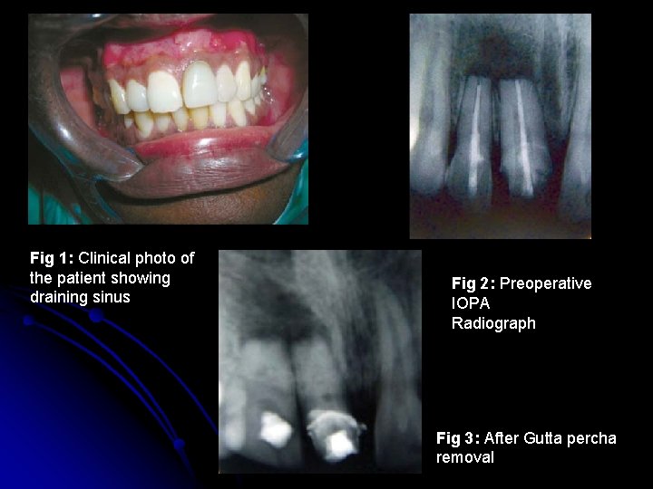 Fig 1: Clinical photo of the patient showing draining sinus Fig 2: Preoperative IOPA