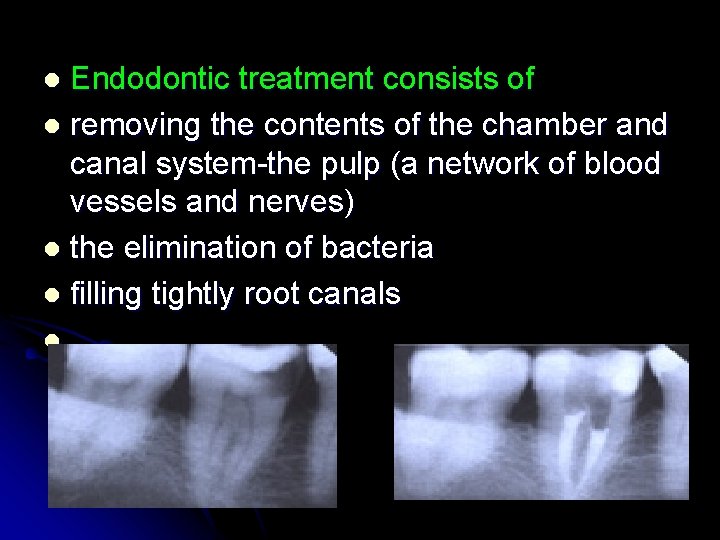 Endodontic treatment consists of l removing the contents of the chamber and canal system-the