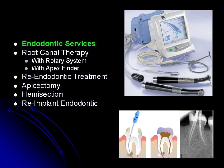 l l Endodontic Services Root Canal Therapy l l l With Rotary System With