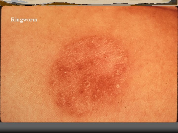 Ringworm 