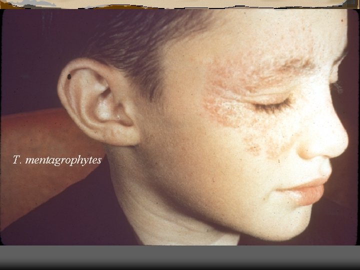 T. mentagrophytes 