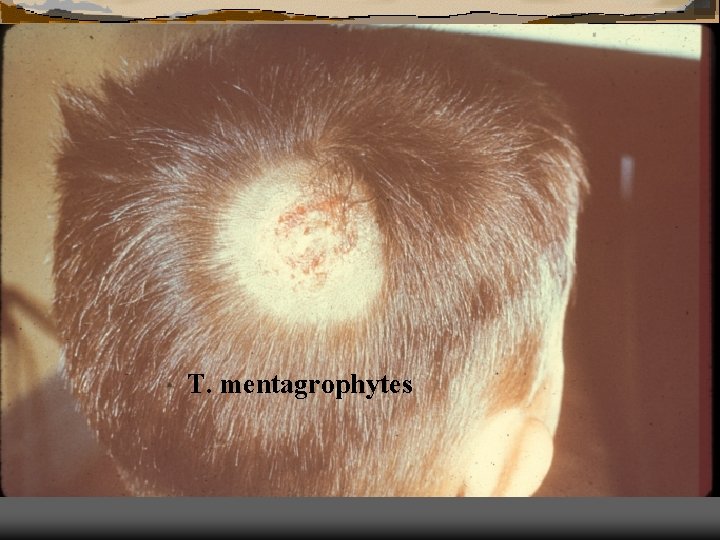 T. mentagrophytes 