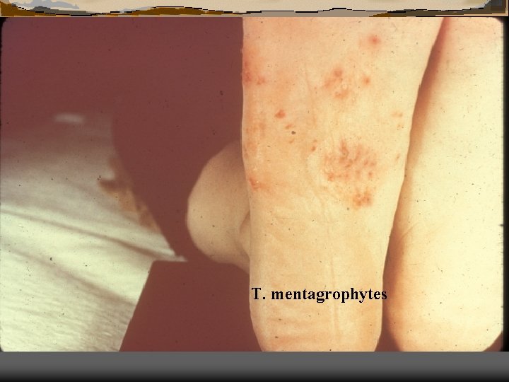 T. mentagrophytes 