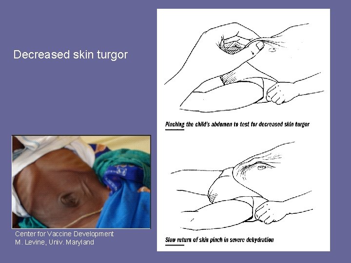 Decreased skin turgor Center for Vaccine Development M. Levine, Univ. Maryland 