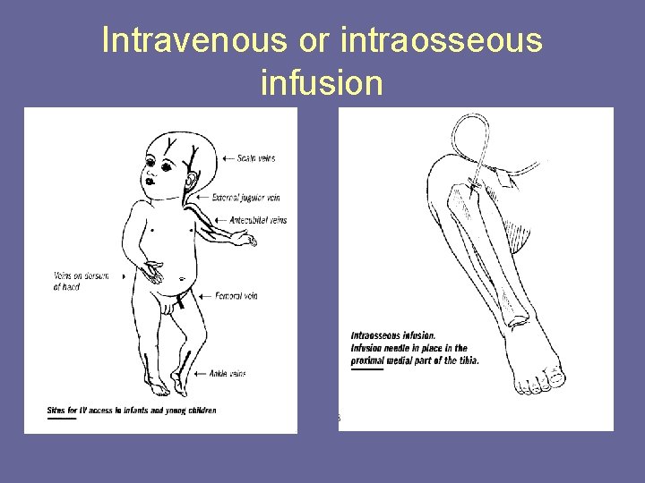 Intravenous or intraosseous infusion 