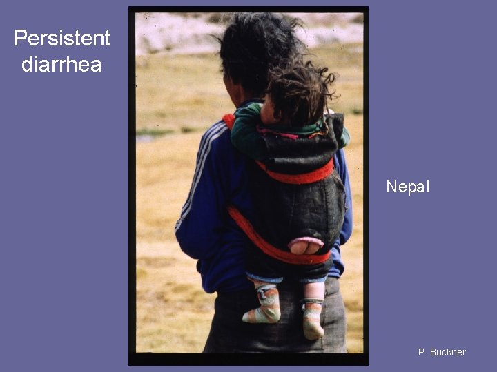 Persistent diarrhea Nepal P. Buckner 