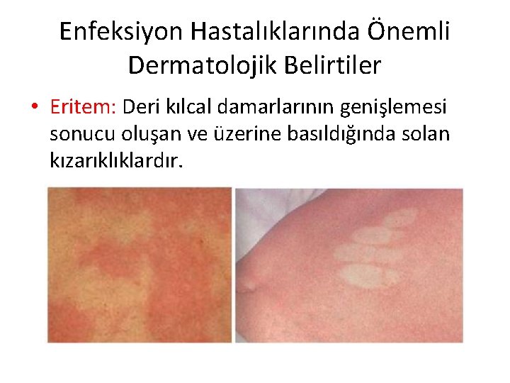 Enfeksiyon Hastalıklarında Önemli Dermatolojik Belirtiler • Eritem: Deri kılcal damarlarının genişlemesi sonucu oluşan ve