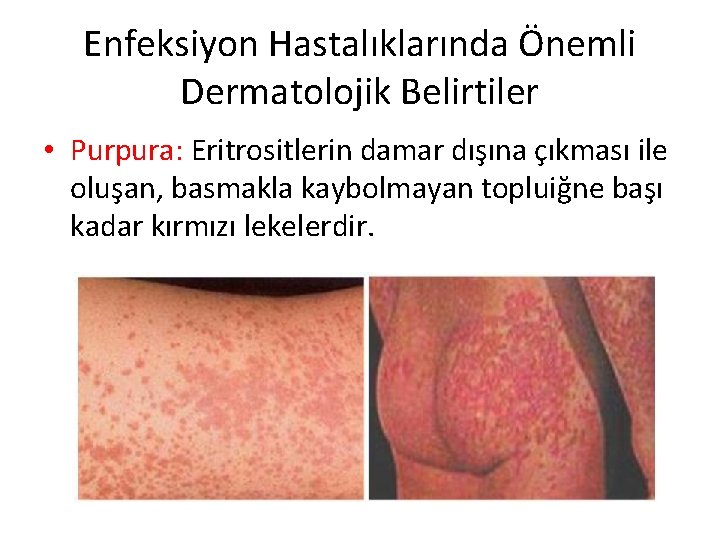Enfeksiyon Hastalıklarında Önemli Dermatolojik Belirtiler • Purpura: Eritrositlerin damar dışına çıkması ile oluşan, basmakla