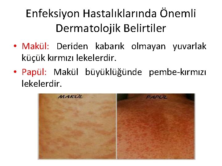 Enfeksiyon Hastalıklarında Önemli Dermatolojik Belirtiler • Makül: Deriden kabarık olmayan yuvarlak küçük kırmızı lekelerdir.