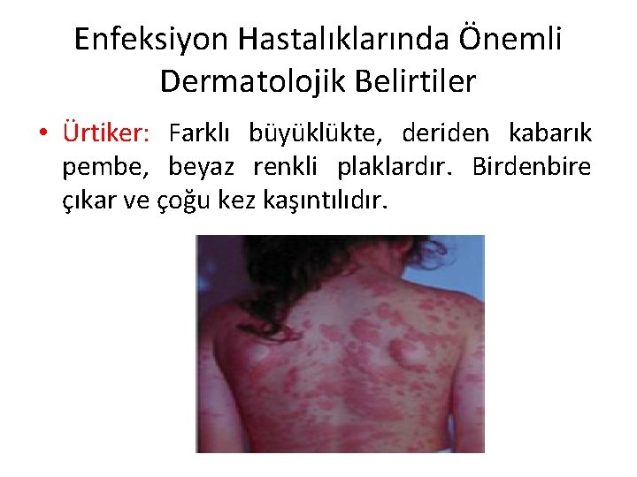 Enfeksiyon Hastalıklarında Önemli Dermatolojik Belirtiler • Ürtiker: Farklı büyüklükte, deriden kabarık pembe, beyaz renkli