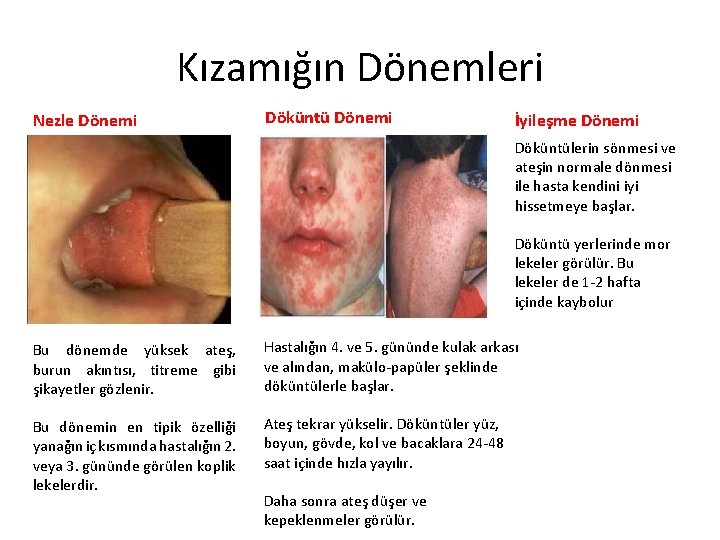 Kızamığın Dönemleri Nezle Dönemi Döküntü Dönemi İyileşme Dönemi Döküntülerin sönmesi ve ateşin normale dönmesi