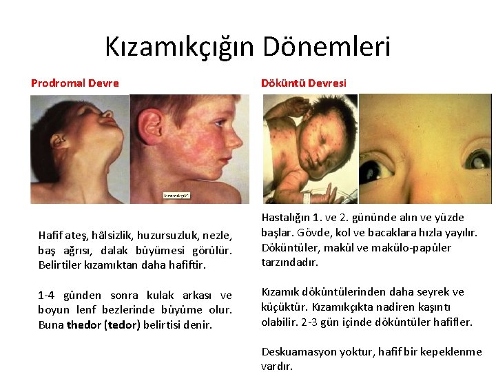 Kızamıkçığın Dönemleri Prodromal Devre Döküntü Devresi Hafif ateş, hâlsizlik, huzursuzluk, nezle, baş ağrısı, dalak