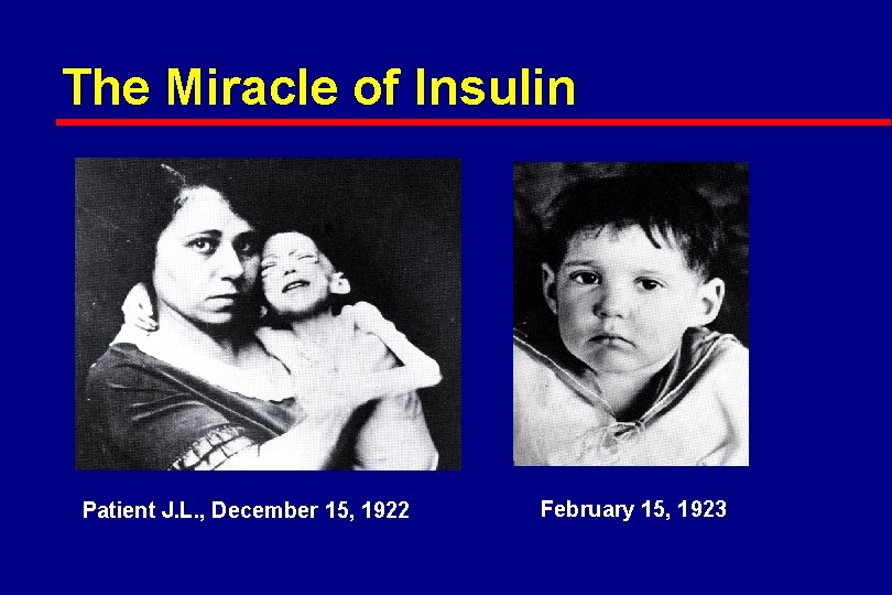 The Miracle of Insulin Patient J. L. , December 15, 1922 February 15, 1923