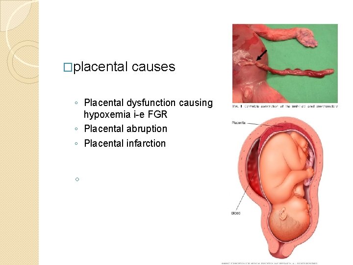 �placental causes ◦ Placental dysfunction causing hypoxemia i-e FGR ◦ Placental abruption ◦ Placental