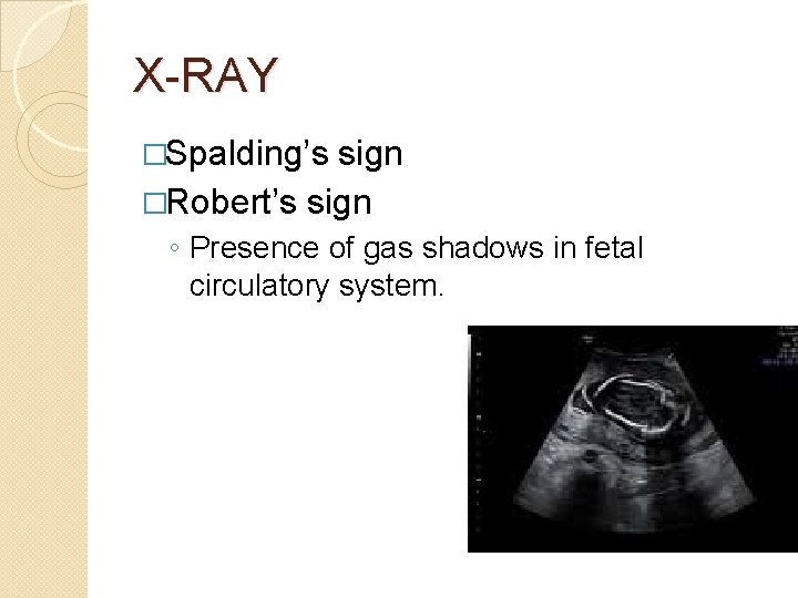 X-RAY �Spalding’s sign �Robert’s sign ◦ Presence of gas shadows in fetal circulatory system.