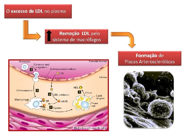 O excesso de LDL no plasma Remoção LDL pelo sistema de macrófagos Formação de