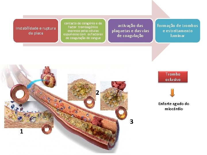 Instabilidade e ruptura da placa contacto de colagénio e do factor trombogénico expresso pelas